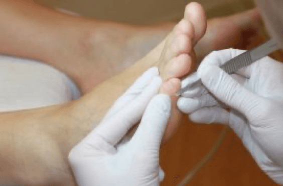 Eelt bij kleine teen wordt door pedicure verwijderd met een mesje
